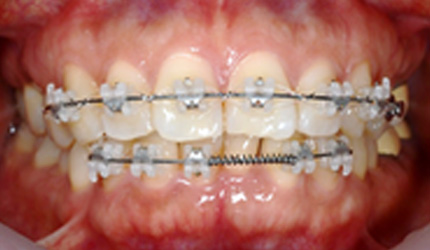 위아래 앞니 6개씩만 부착하는 부분교정 사례 - 8개월만에 교정 종료한 경우(부분교정 진행중)