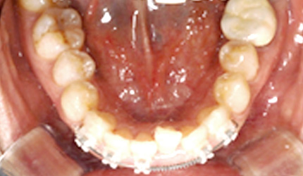 위아래 앞니 6개씩만 부착하는 부분교정 사례 - 8개월만에 교정 종료한 경우(부분교정 진행중)