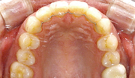 위아래 앞니 6개씩만 부착하는 부분교정 사례 - 8개월만에 교정 종료한 경우(부분교정 후)