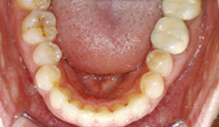 위아래 앞니 6개씩만 부착하는 부분교정 사례 - 8개월만에 교정 종료한 경우(부분교정 후)