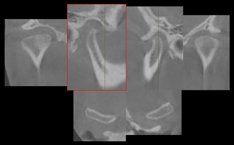 우측 턱관절에서의 형태 이상