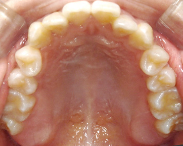 좁은 입천장을 교정치료를 통해 확장